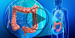 Ilustrasi kanker usus besar (Sumber : Oncology Central)