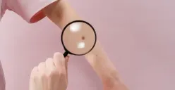 Ilustrasi kanker kulit (Sumber : pexels)