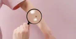 Waspadai Kanker Kulit Mematikan, Kenali Ciri-cirinya Sebelum Terlambat!