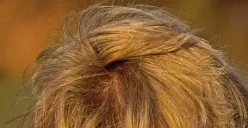 Ilustrasi kulit kepala (Sumber : Pixabay)