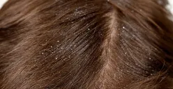 Ilustrasi ketombe (Sumber : Pexels)