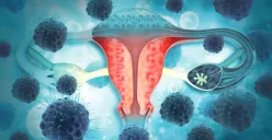 Ilustrasi kanker ovarium (Sumber : Pexels)