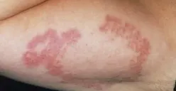 Ruam Kulit Dapat Disembuhkan dengan Obat Homeopati, lho!