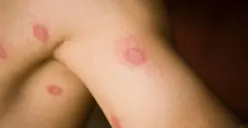 Ilustrasi kurap atau infeksi jamur di kulit