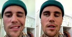 Justin Bieber terkena Ramsay Hunt Syndrome (Sumber : Instagram)