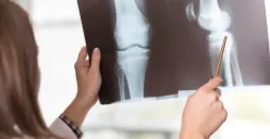 Ilustrasi osteoporosis