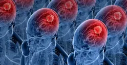 Inilah Gejala Tumor Otak yang Terlihat di Mata dan Wajah, Apa Saja?