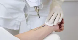Ilustrasi menghapus tato dengan laser. (Sumber : Freepik)
