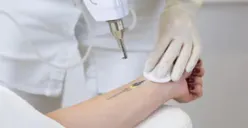 Hukum Menghapus Tato Menurut Islam, Wajib atau Tidak?