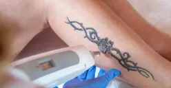 Jangan Asal, Ini 4 Cara Aman Hapus Tato Menurut Medis