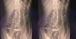 Tidak BAB Satu Bulan, Dokter Temukan Usus Pasien Naik Sampai Dada! Berikut cara atasi sembelit atau susah BAB (Sumber : twitter.com/BaseAnakFK)