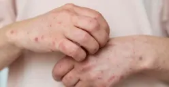 Ilustrasi. Kenali gejala dan cara cegah penyakit menular cacar monyet atau MPOX. (Sumber : Freepik)