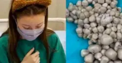 Dokter Temukan 300 Batu Ginjal di Tubuh Wanita Muda Gegara Jarag Minum Air Putih, Termasuk Bisa Sebabkan 7 Hal Lainnya Ini (Sumber : instagram.com/folkshitt)