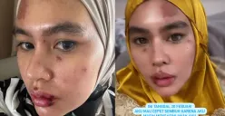 Wajah Kartika Putri penuh luka-luka diduga karena autoimun. (Sumber: @kartikaputriworld - InfoSemarang.com)