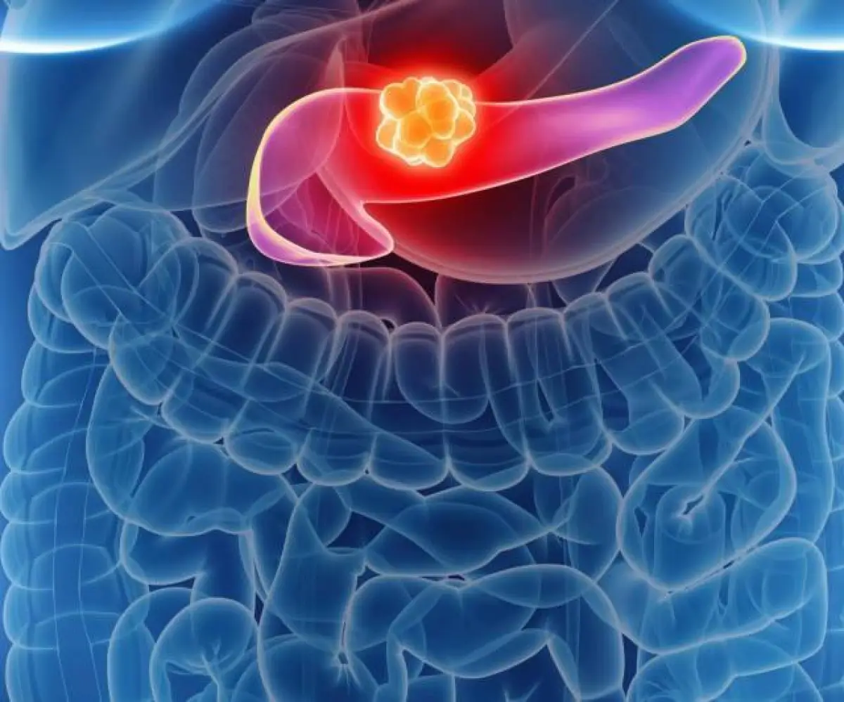 ilustrasi kanker pankreas (Sumber : Pexels)