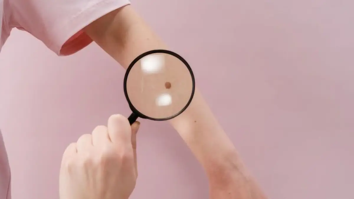 Ilustrasi kanker kulit (Sumber : pexels)