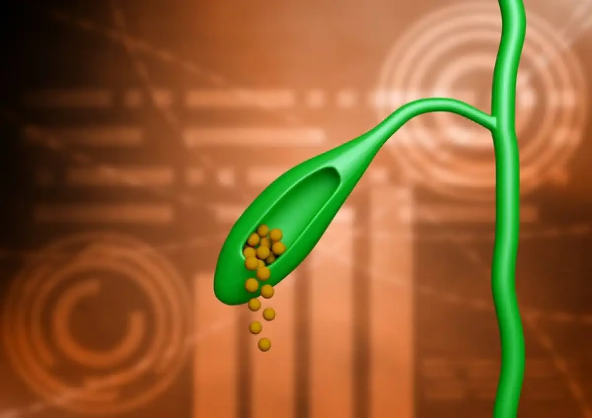 Ilustrasi batu empedu