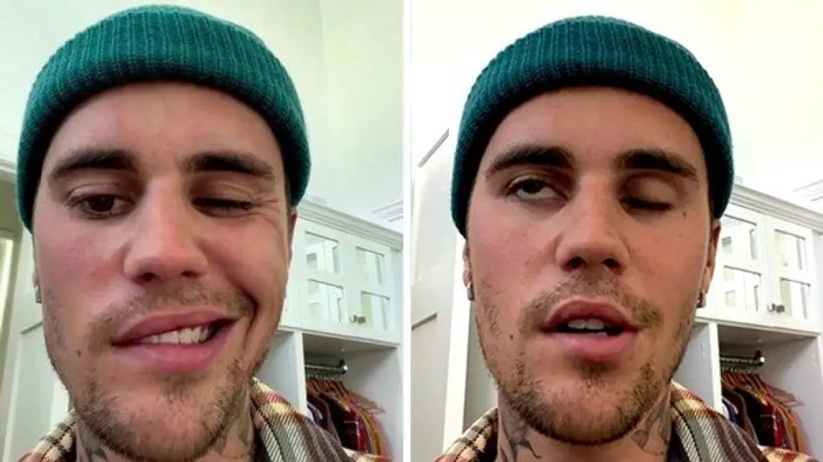 Justin Bieber terkena Ramsay Hunt Syndrome (Sumber : Instagram)