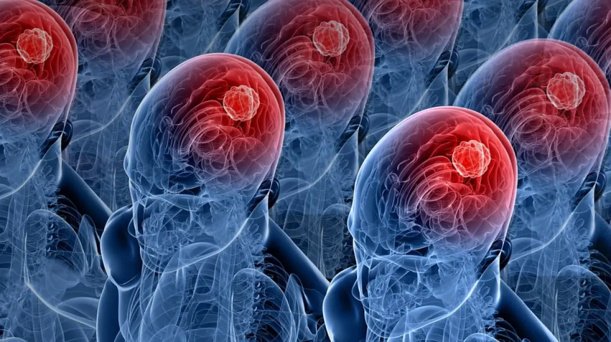 Ilustrasi tumor otak (Sumber : Pixabay)