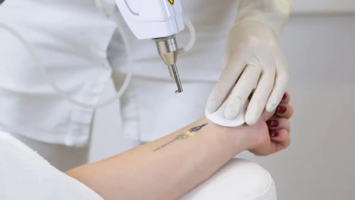 Ilustrasi menghapus tato dengan laser. (Sumber : Freepik)