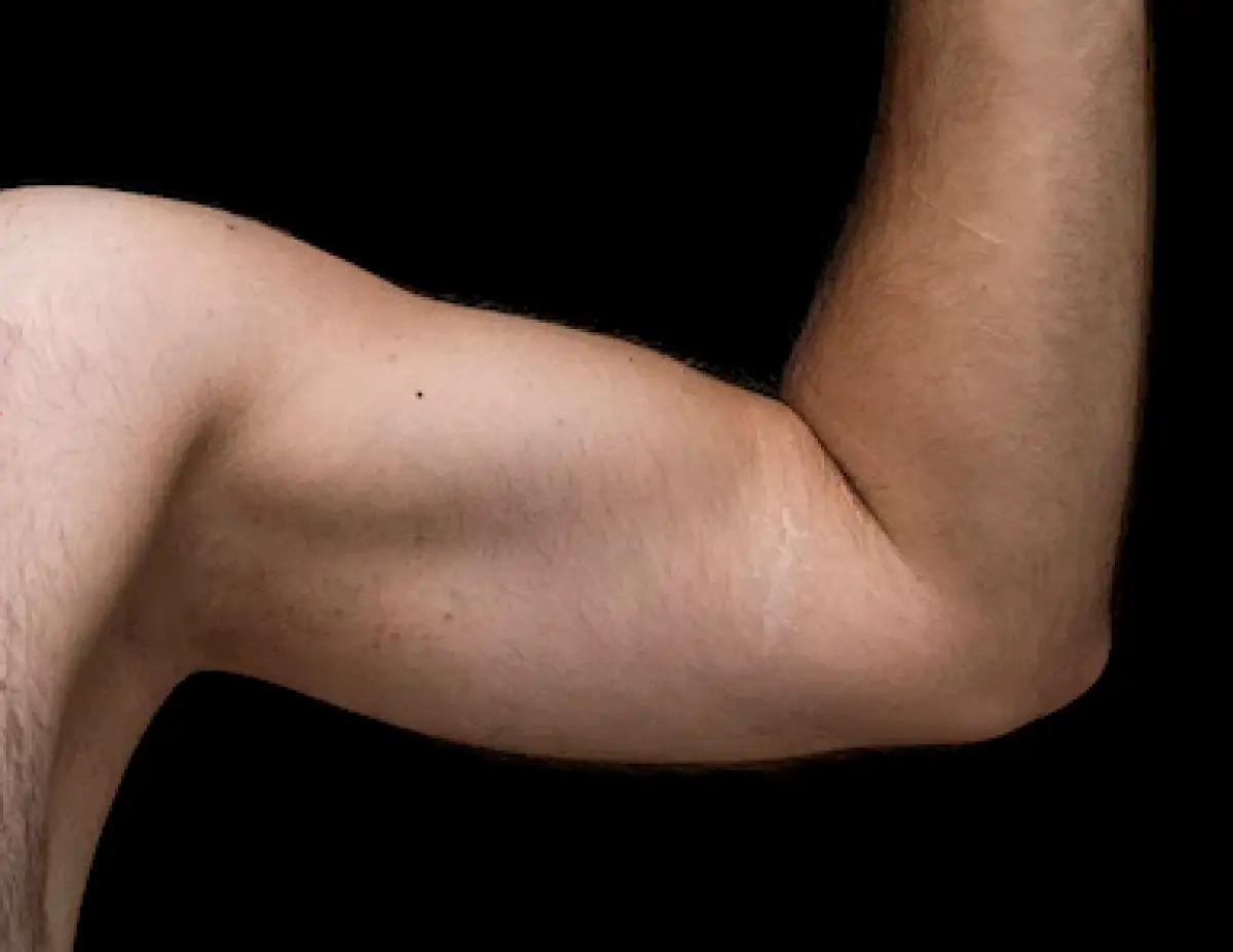 Illustrasi stretch mark (Sumber : Unsplash/engin akyurt)