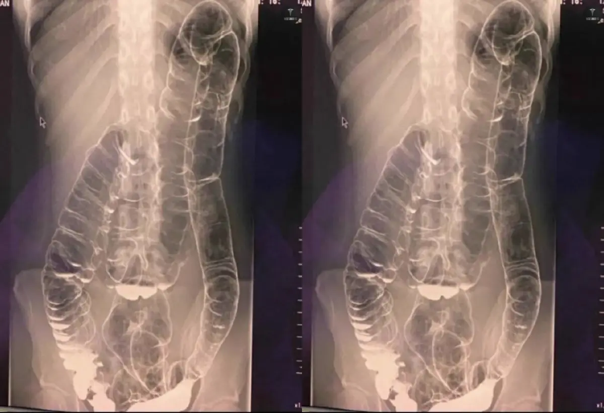 Tidak BAB Satu Bulan, Dokter Temukan Usus Pasien Naik Sampai Dada! Berikut cara atasi sembelit atau susah BAB (Sumber : twitter.com/BaseAnakFK)