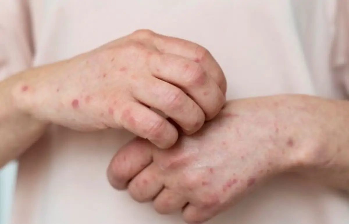 Penyebab, gejala dan penyebaran cacar monyet (Sumber : Freepik)