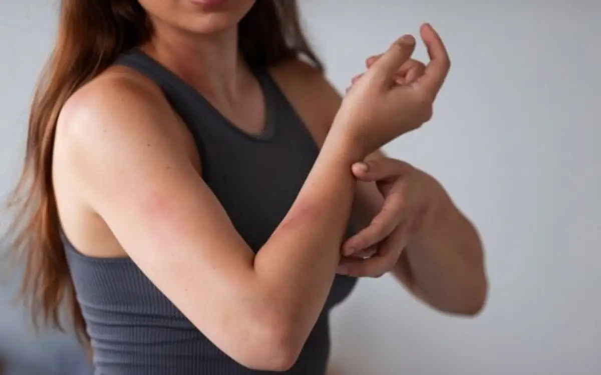 ilustrasi : tubuh memar tanpa sebab bisa karena penyakit ini (Sumber : freepik)