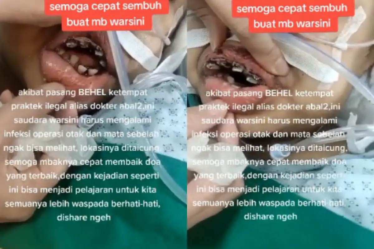 Kisah Warsini yang alami infeksi otak usai pasang behel di klinik abal-abal (Sumber : Tiktok/lolita6428)