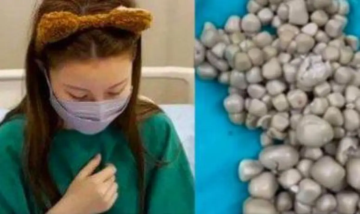 Dokter Temukan 300 Batu Ginjal di Tubuh Wanita Muda Gegara Jarag Minum Air Putih, Termasuk Bisa Sebabkan 7 Hal Lainnya Ini (Sumber : instagram.com/folkshitt)