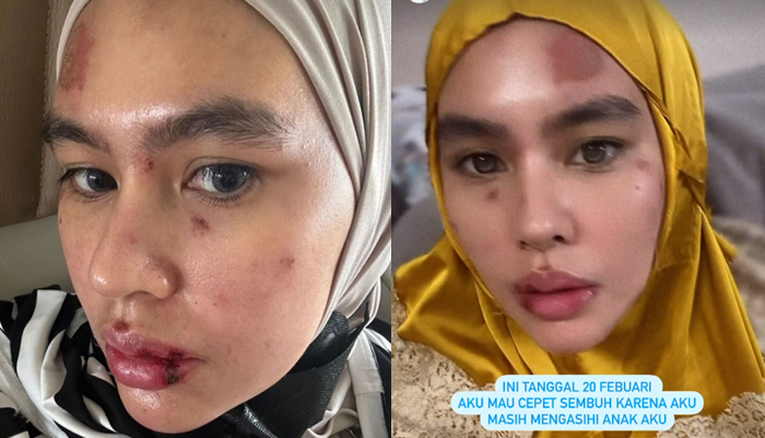 Wajah Kartika Putri penuh luka-luka diduga karena autoimun. (Sumber: @kartikaputriworld - InfoSemarang.com)